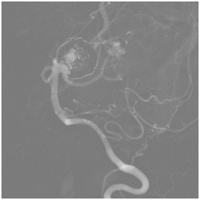 Under GA coil embolization