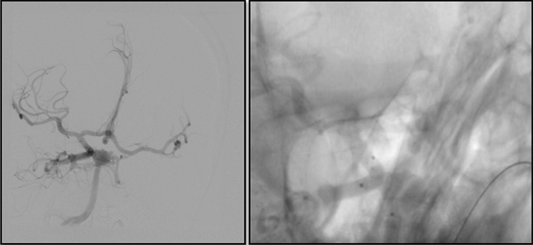 Unexpected complication of stent assisted aneurysm coiling in presence of complex anatomical variation