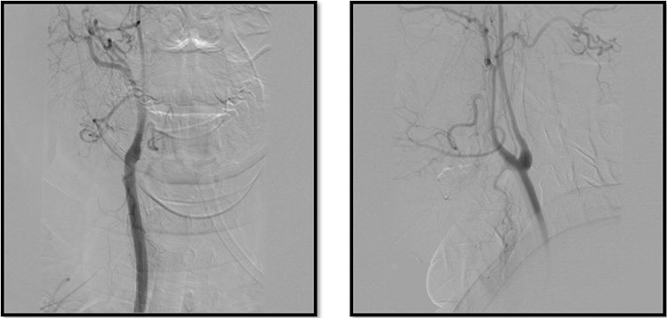 Unexpected complication of stent assisted aneurysm coiling in presence of complex anatomical variation