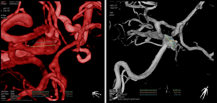 Unexpected complication of stent assisted aneurysm coiling in presence of complex anatomical variation