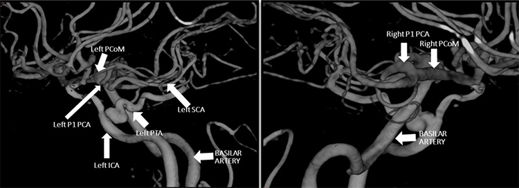 Unexpected complication of stent assisted aneurysm coiling in presence of complex anatomical variation