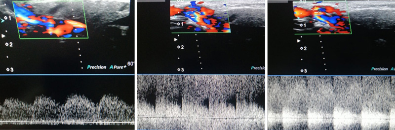 Venous / Arterial / at fistula site