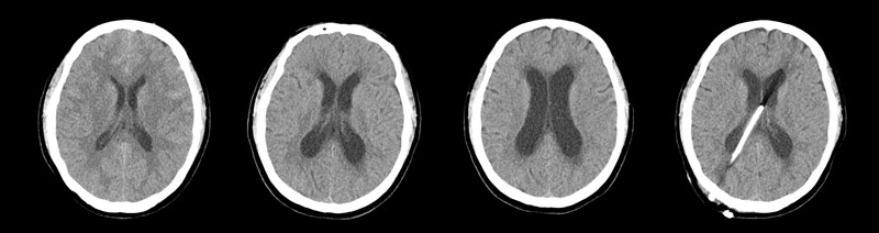VP shunt for progressed hydrocephalus