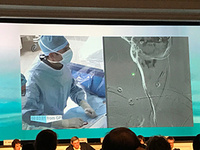 an iatrogenic ICA dissection had occurred at the lower cervical segment