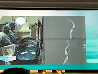 ICA occlusion responsible for an acute stroke