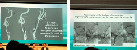 technical aspect of endovascular recanalization of chronic ICA occlusion