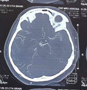 image1-dissecting-aneurysm-with-moya-moya