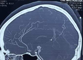 image2-dissecting-aneurysm-with-moya-moya