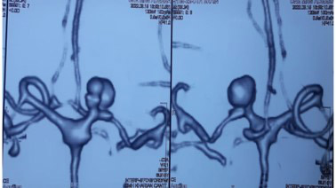 image3-dissecting-aneurysm-with-moya-moya