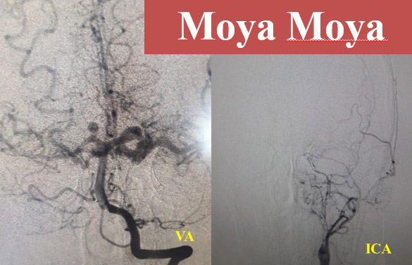 image4-dissecting-aneurysm-with-moya-moya