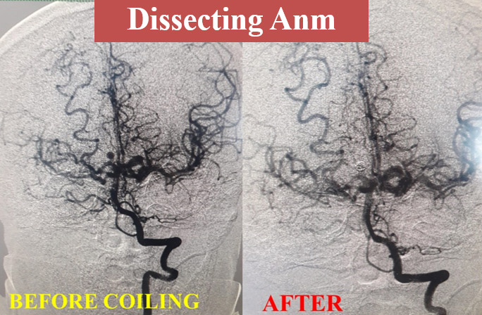 image5-dissecting-aneurysm-with-moya-moya