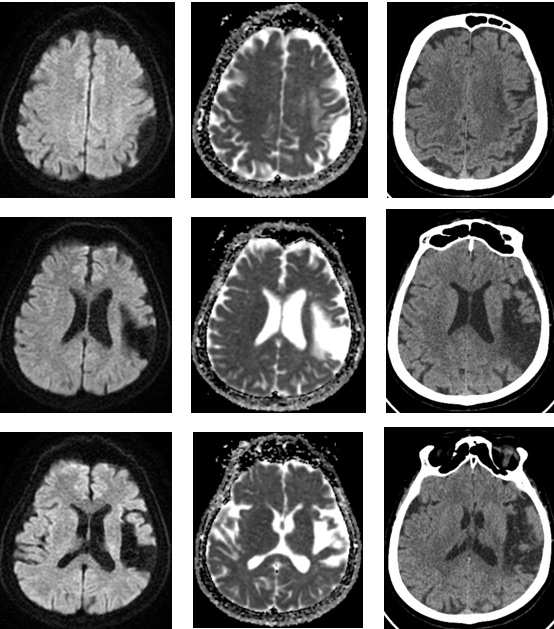 1-double-stent-retriever-mechanica-thrombectomy-ct-and-mri-from-2015