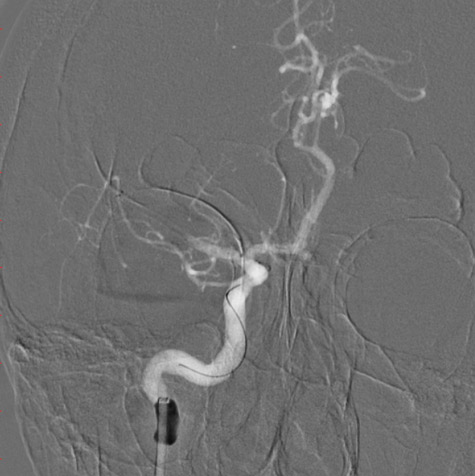 10-double-stent-retriever-mechanica-thrombectomy-single-stent-retriever-thrombectomy-failed-2