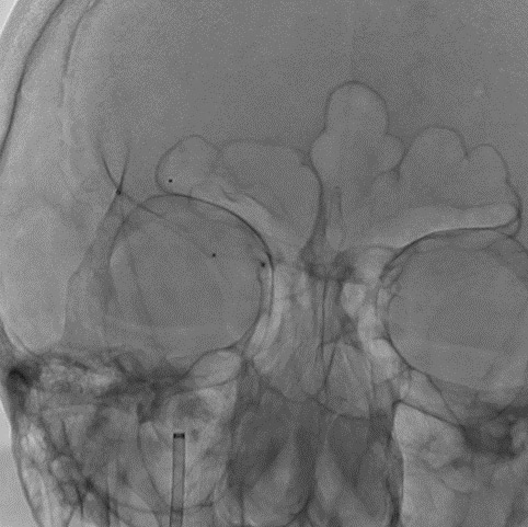 13-double-stent-retriever-mechanica-thrombectomy-both-of-the-r-mca-trunks-catheterized-2