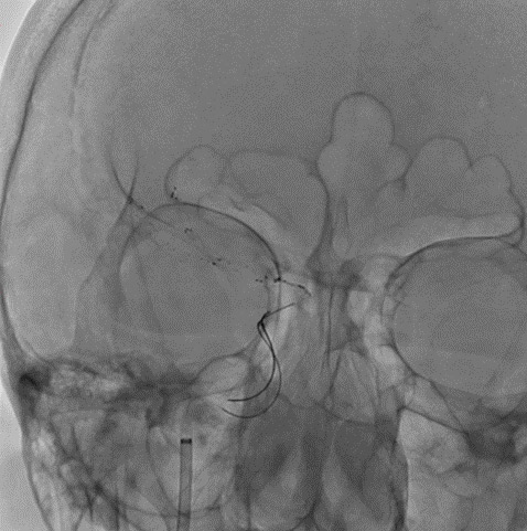 14-double-stent-retriever-mechanica-thrombectomy-both-of-the-r-mca-trunks-catheterized-3