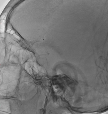 16-double-stent-retriever-mechanica-thrombectomy-deployement-of-stent-retrievers-2