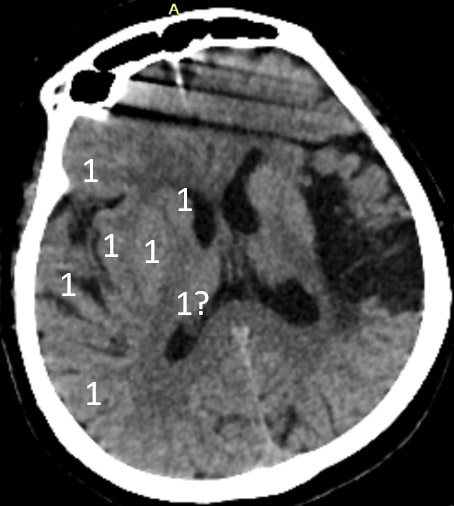 4-double-stent-retriever-mechanica-thrombectomy-aspect-score-1