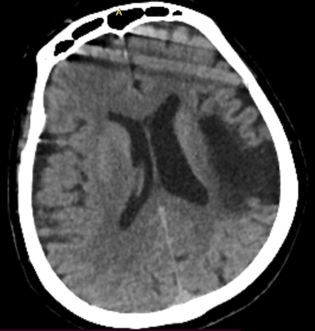 5-double-stent-retriever-mechanica-thrombectomy-aspect-score-2