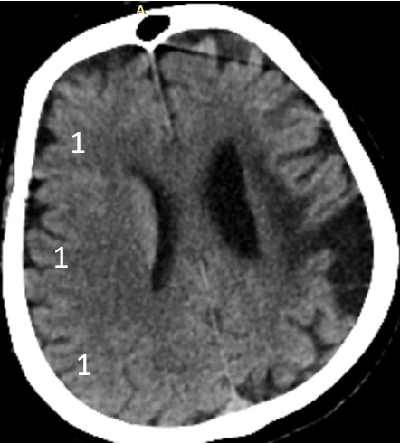 6-double-stent-retriever-mechanica-thrombectomy-aspect-score-3