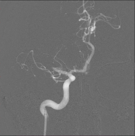 7-double-stent-retriever-mechanica-thrombectomy-8f-balloon-guiding-catheter-1