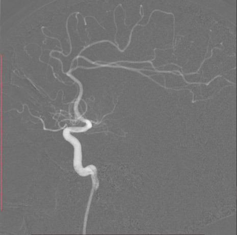 8-double-stent-retriever-mechanica-thrombectomy-8f-balloon-guiding-catheter-2