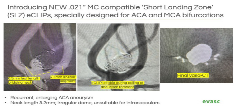 Introducing NEW.021" MC compatible "Short Landing Zone" (SLZ) eCLIPs, specially designed for ACA and MCA bifurcations