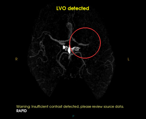 Left distal MCA occlusion (circle)