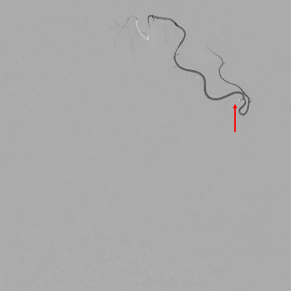 Microcatheter injection (tip arrow) - Stent deployed (arrows)