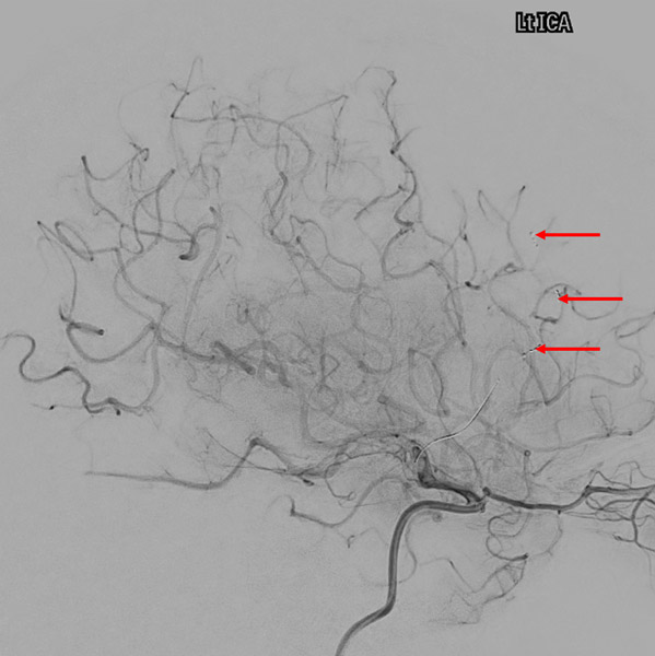 Microcatheter injection (tip arrow) - Stent deployed (arrows)