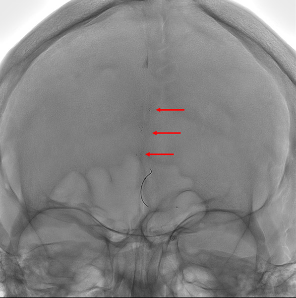 Stentriever deployed (arrows)
