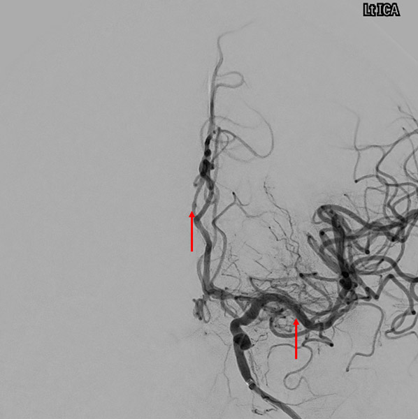 TICI 3, minor ACA spasm