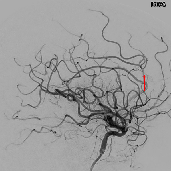 TICI 3, minor ACA spasm