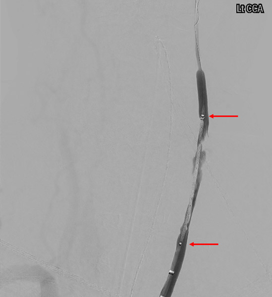 Stent (arrows) deployment through BGC