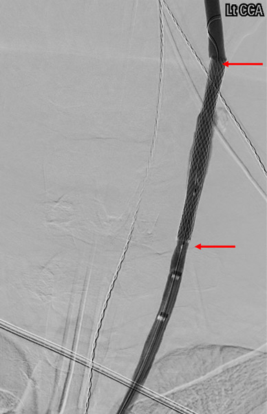 Stent (arrows) deployment through BGC