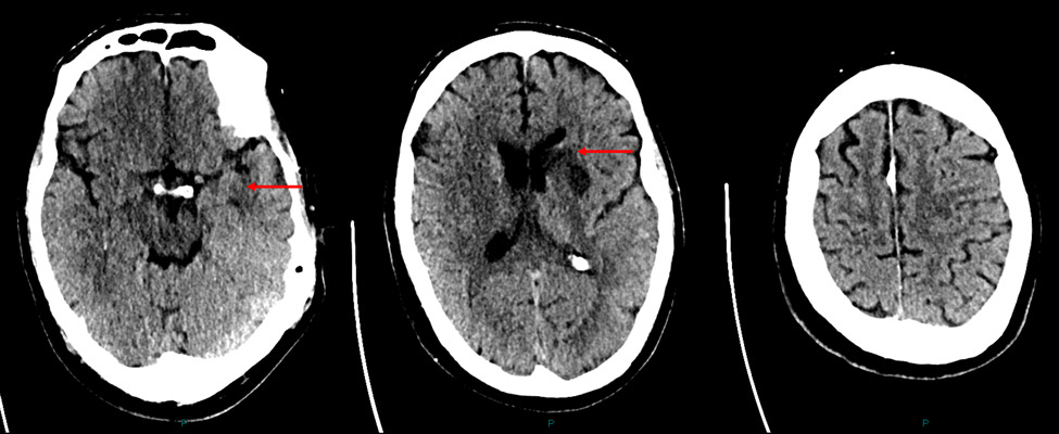 24 hour NCCT- small volume infarction