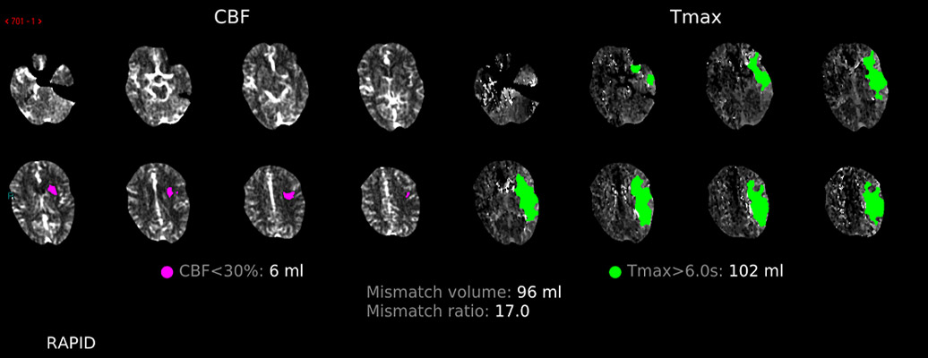 CTP Summary – large potentially salvageable ‘penumbra’ (green) v small core (pink)