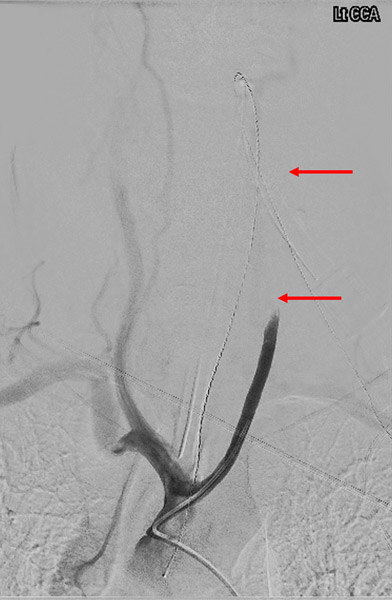 Initial Angiography- tandem occlusion (arrows)