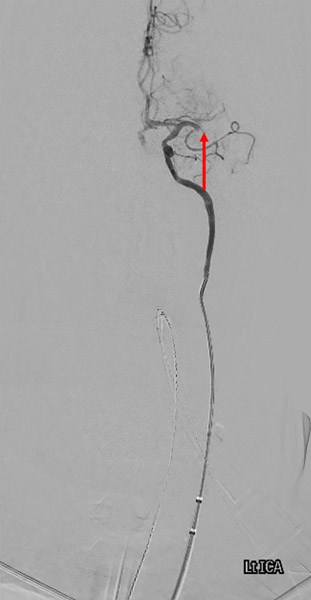 Initial Angiography- tandem occlusion (arrows)