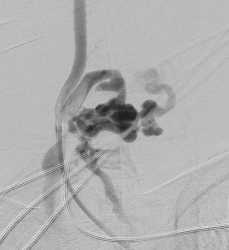 image1-incidental-occlusion-of-right-vertebral-artery-due-to-onyx-digital-subtractial-angiography-spinal-av-fistula-1