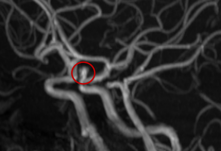 image1-Krug-Intimal-Hyperplasia-mri-tof