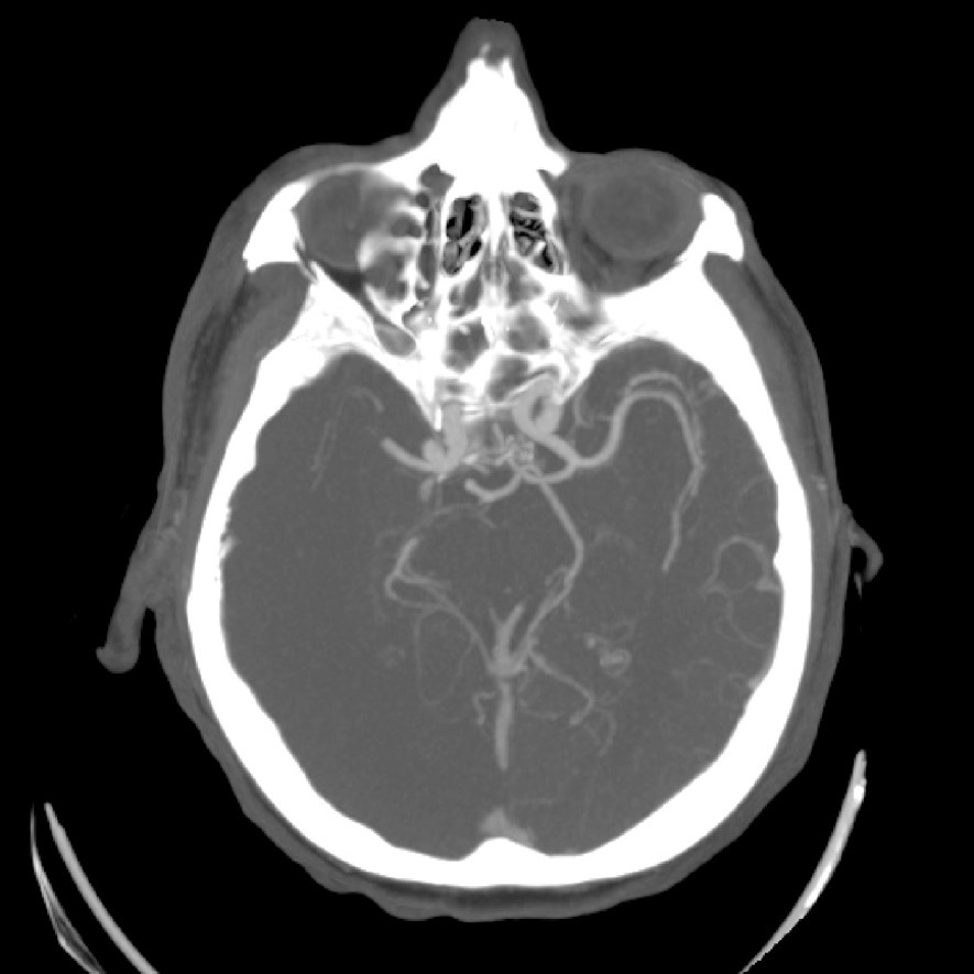 image1-mechanical-thrombectomy-in-double-occlusion-stroke