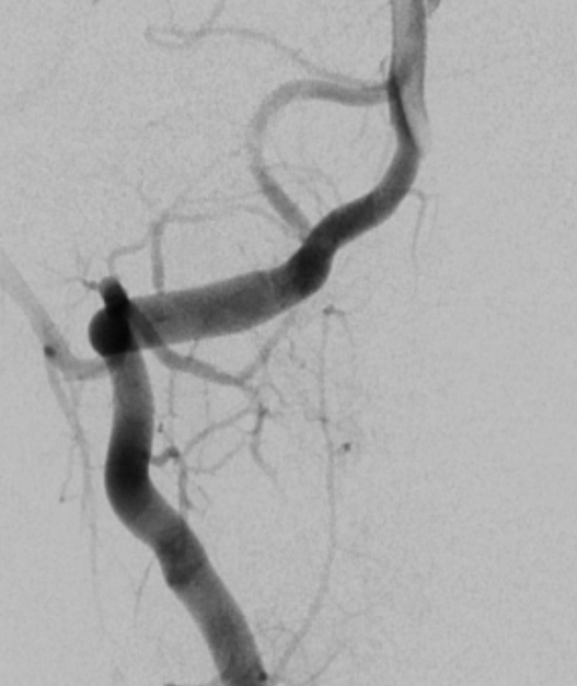 image10-incidental-occlusion-of-right-vertebral-artery-due-to-onyx-control-angiography-show-fullpreservation-vertebral-artery