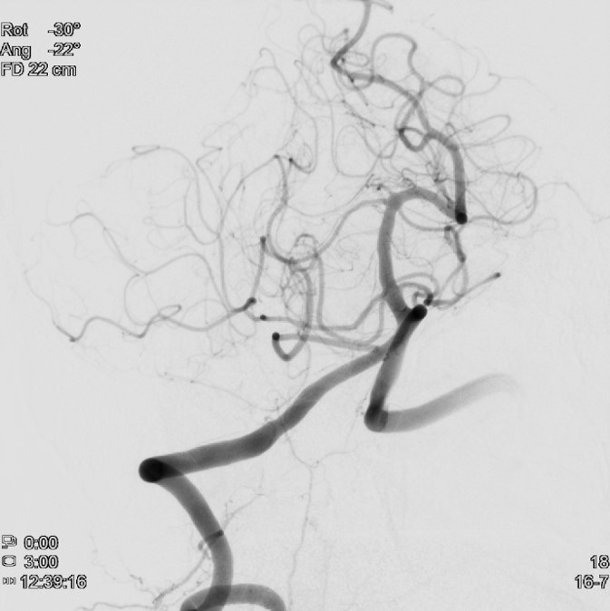 image10-mechanical-thrombectomy-in-double-occlusion-stroke