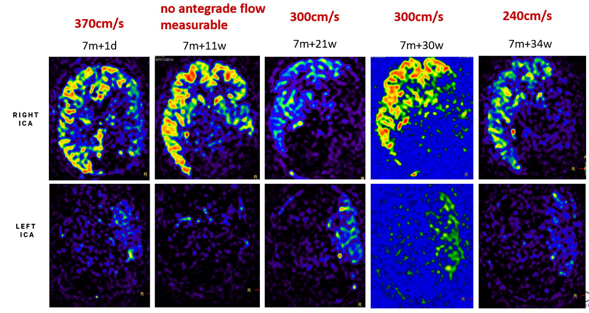 image11-Krug-Intimal-Hyperplasia-doppler-ultrasound-flow-velocity-of-proximal-left-m1-segment