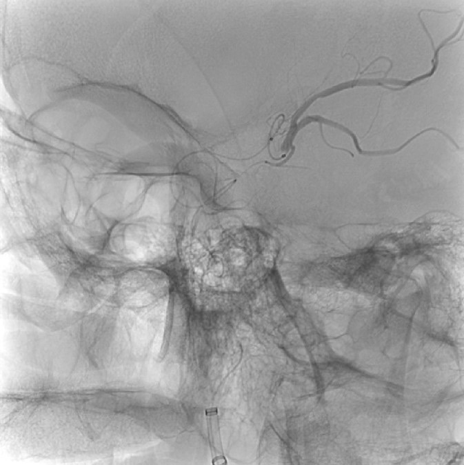 image13-mechanical-thrombectomy-in-double-occlusion-stroke