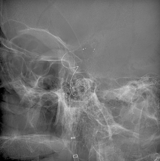 image15-mechanical-thrombectomy-in-double-occlusion-stroke
