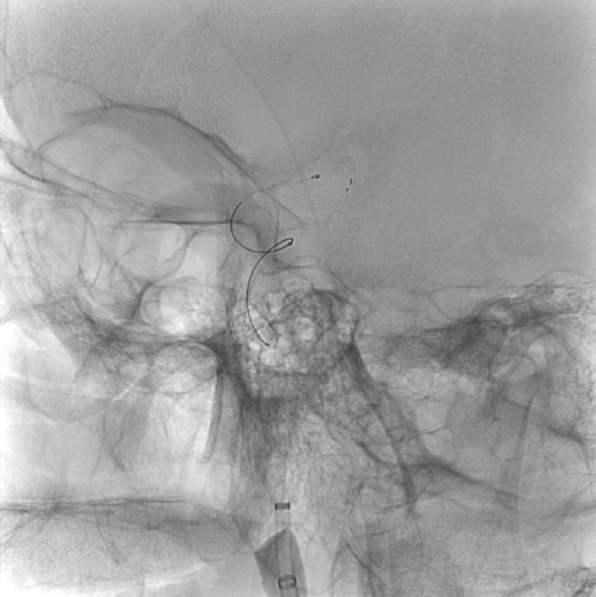 image16-mechanical-thrombectomy-in-double-occlusion-stroke