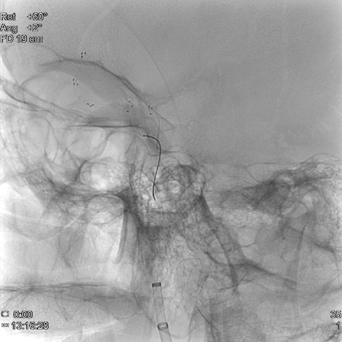 image19-mechanical-thrombectomy-in-double-occlusion-stroke