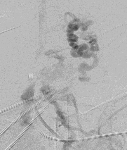 image2-incidental-occlusion-of-right-vertebral-artery-due-to-onyx-digital-subtractial-angiography-spinal-av-fistula-2