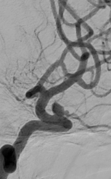image2-Krug-Intimal-Hyperplasia-left-ica